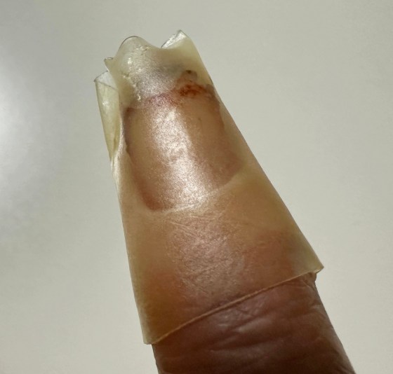 あくる日、血を拭きとって、折れた爪は1か月ぐらいでくっつくそう